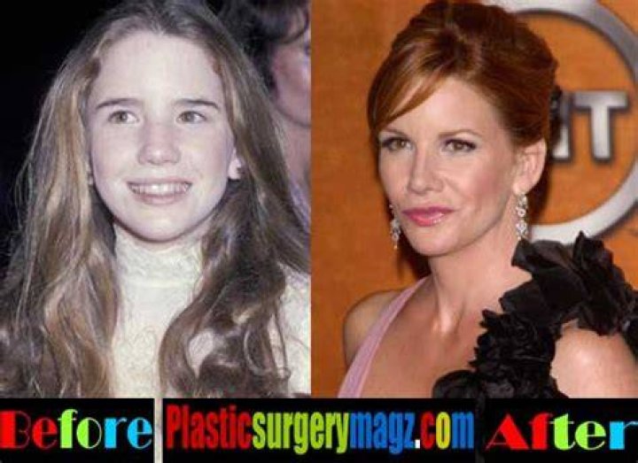 Celebrity Melissa Gilbert Plastic Surgery Nose Jobe Before After