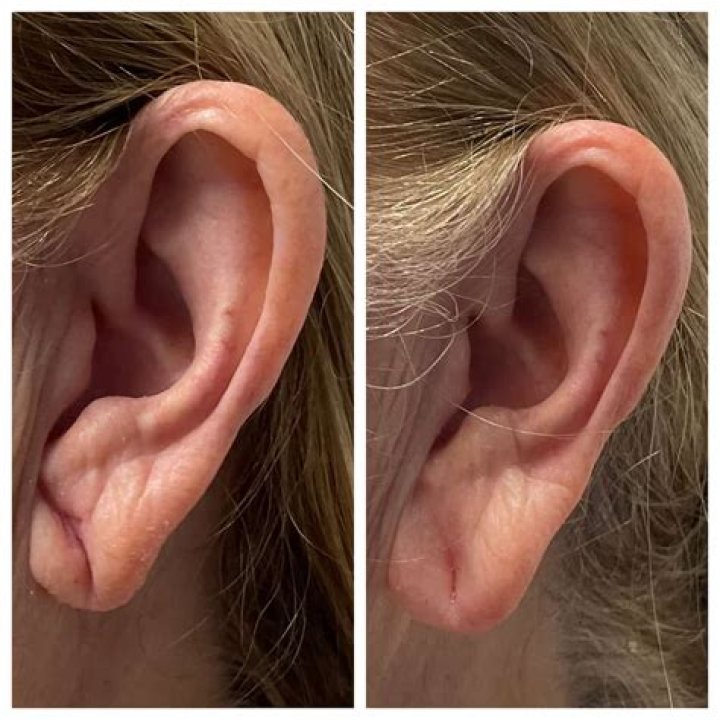 Earlobe fillers yes, it's a... Novice Group Dermatology Facebook