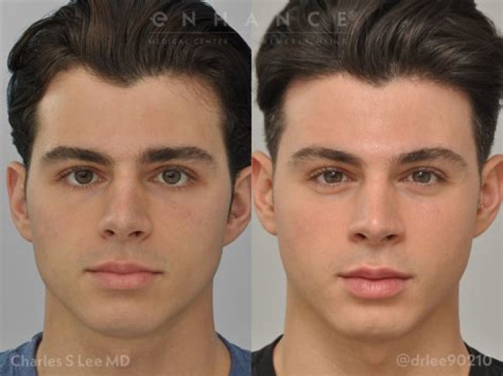 Get Pierre Boo Plastic Surgery Nick And Pierre Before And After US