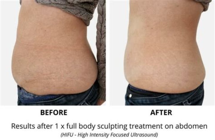 How Does Body Sculpting Actually Work?