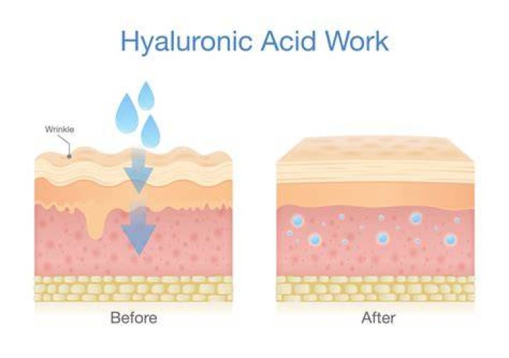 Hyaluronic Acid And Skin Darkness
