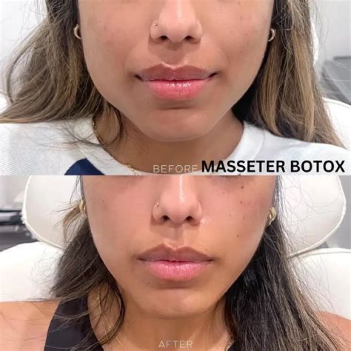 I got Botox to make my skin baby soft... it&rsquo;s actually given me more