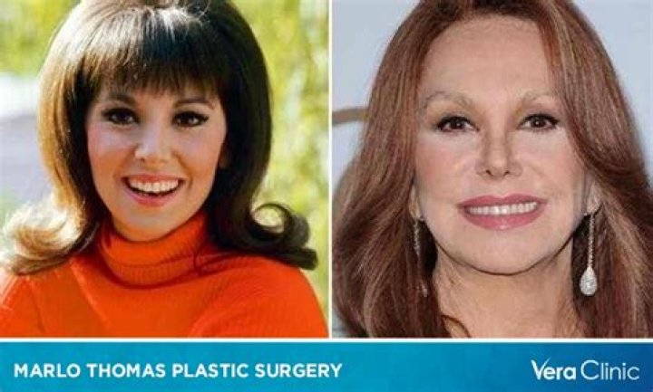 Marlo Thomas' Plastic Surgery Journey: Uncovering Truths And Transformations