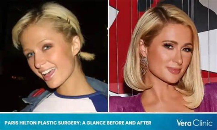 Paris Hilton Plastic Surgery Myths Microcurrent is What's Hot NewBeauty