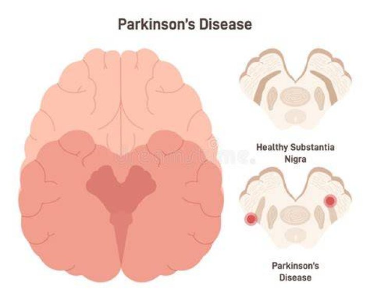 Paul Gosar And Parkinson's Disease