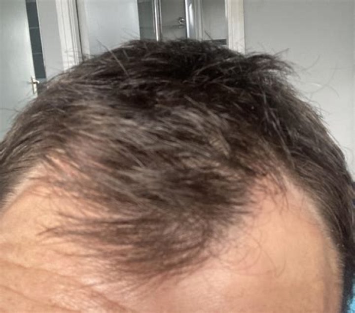 Pete Davidson Takes Finasteride To Prevent Hair Loss Before And After