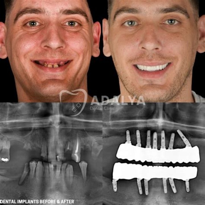 Unveiling Anthony Davis' Dental Transformation: Discoveries And Insights
