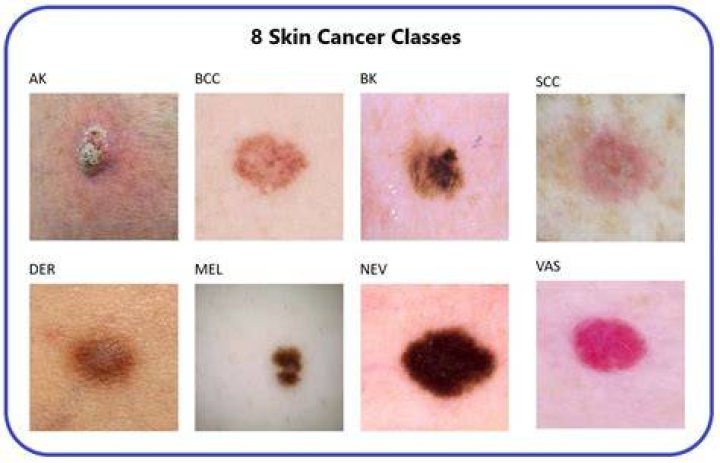 What kind of cancer did Alicia Allain have?