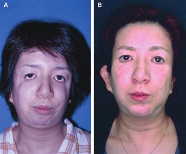 Woman With Treacher Collins Syndrome Fulfills Dream Of A Model