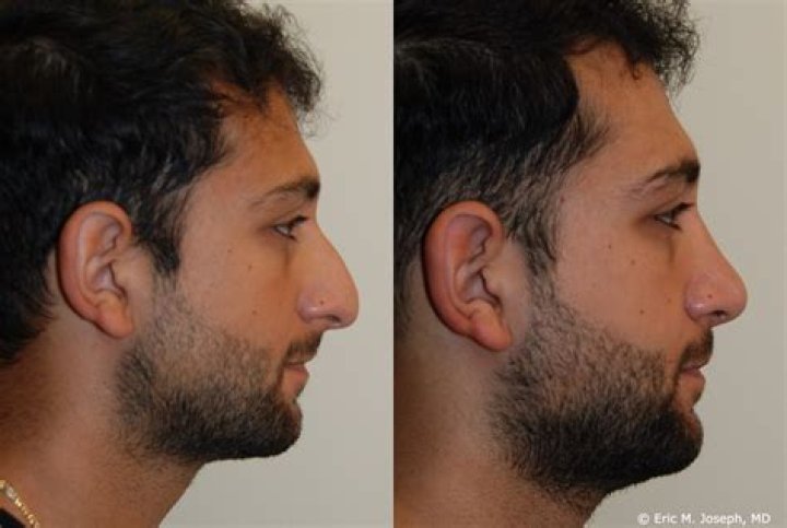 Zach Braff Nose Job Before And After zac efron nose job before and